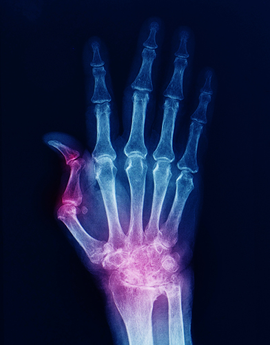 Thumb and Wrist Arthritis | Dr Raymond Yu